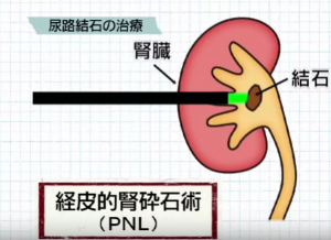 PNL(経皮的結石破砕術)